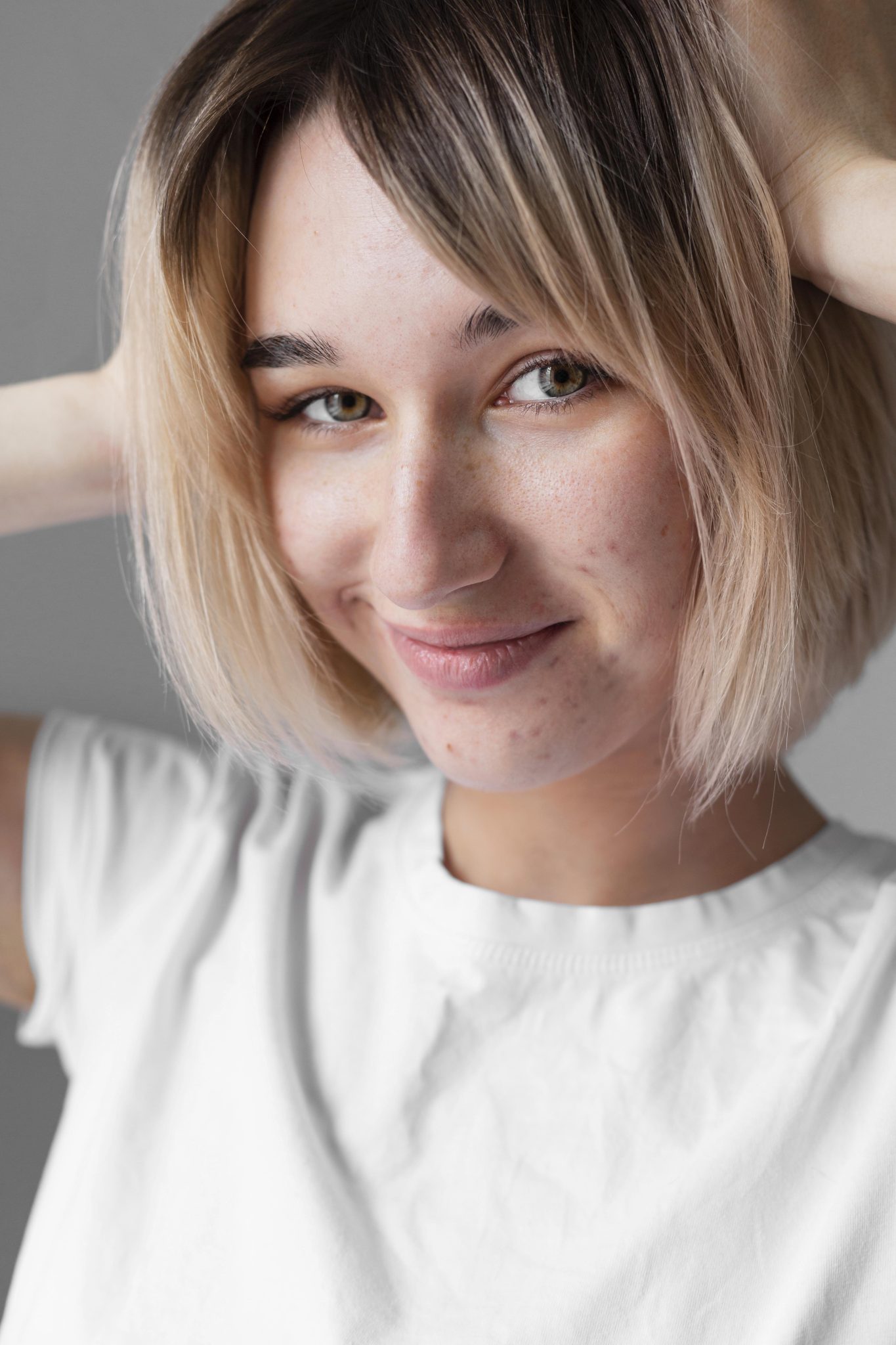 Close-up of a young woman with visible acne scars smiling before acne scar treatment at PUR Skin Clinic