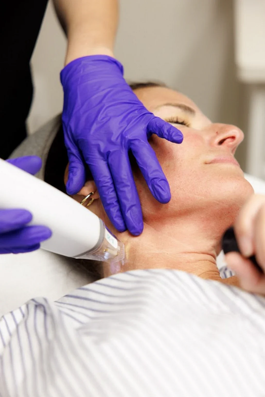 potenza rf in Kirkland and Edmonds (Seattle) at Pur Skin Clinic